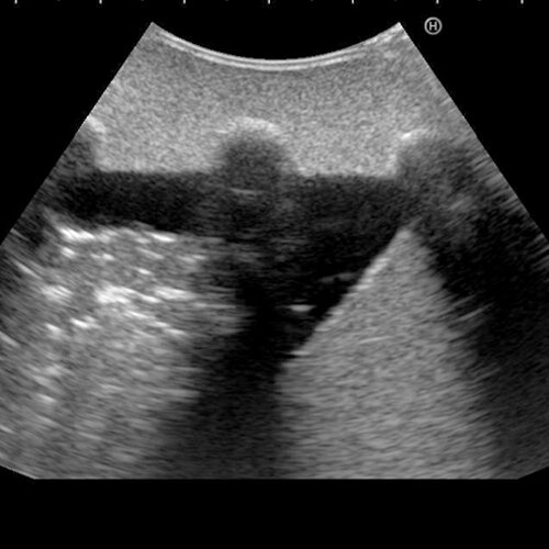 Ultrasound Echo Lung