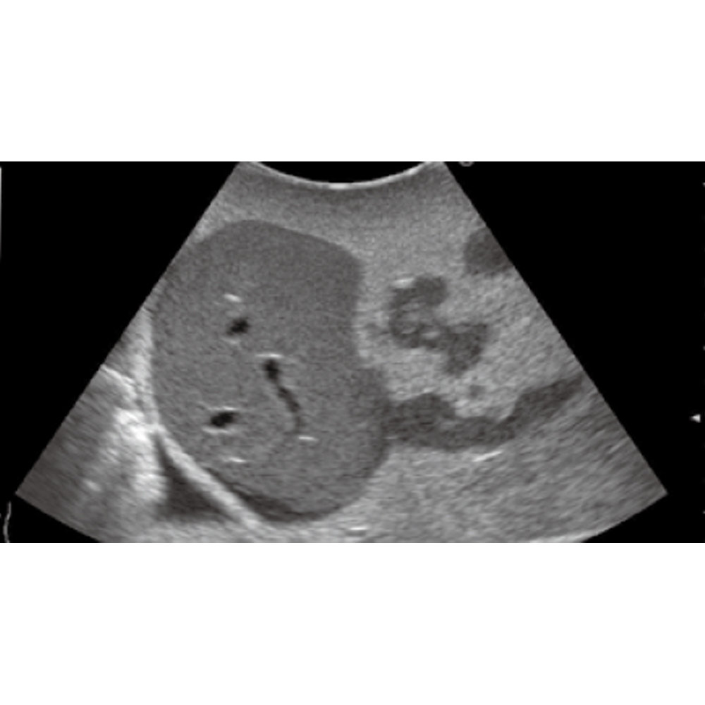 Paediatric FAST/Acute Abdomen Phantom