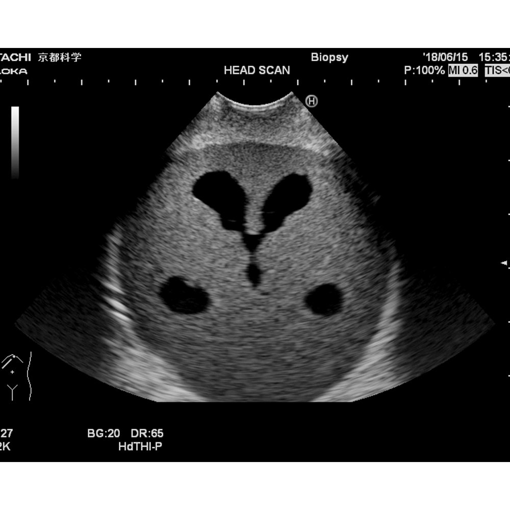 Ultrasound Neonatal Head Phantom (Abnormal type)