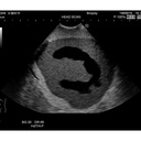 Ultrasound Neonatal Head Phantom (Abnormal type)