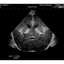 Ultrasound Neonatal Head Phantom (Normal)