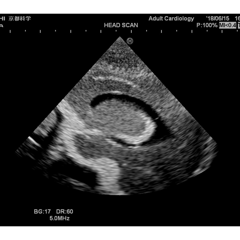 Ultrasound Neonatal Head Phantom (Normal)