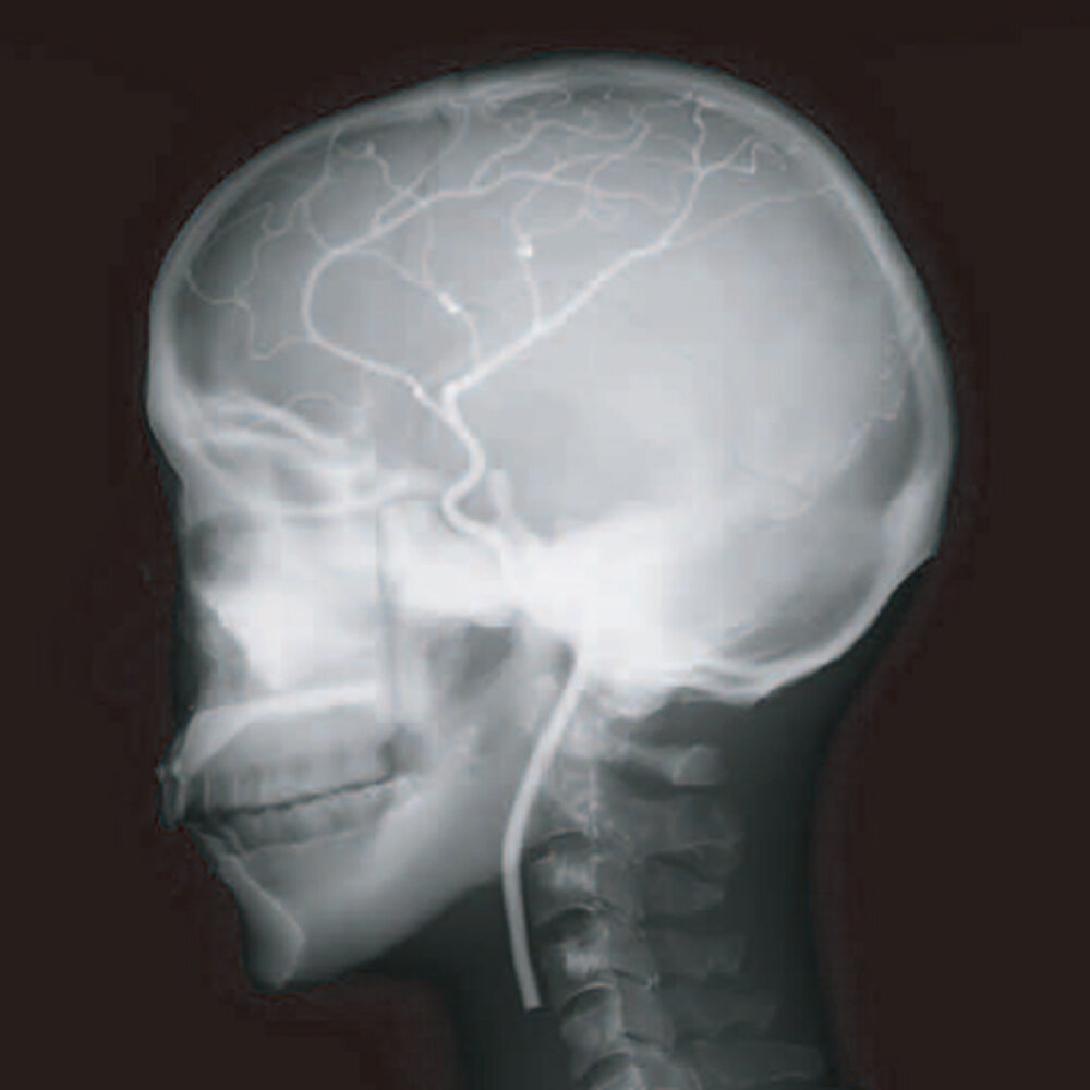 Angiographic CT Head Phantom ACS