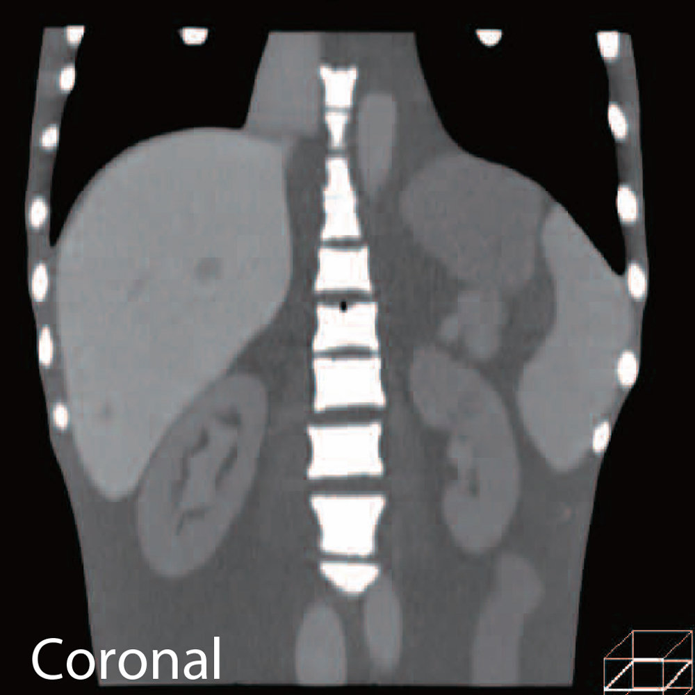 CT Abdomen Phantom