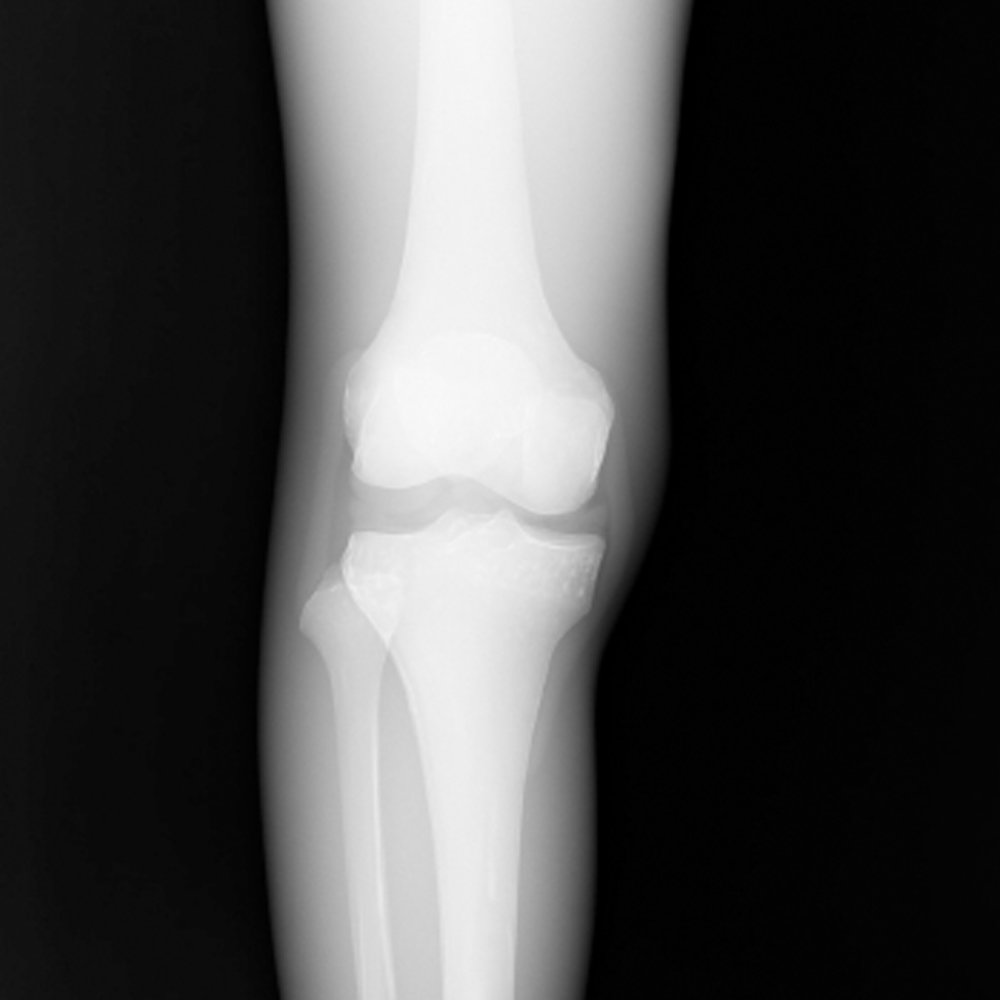 Knee Ligament Phantom