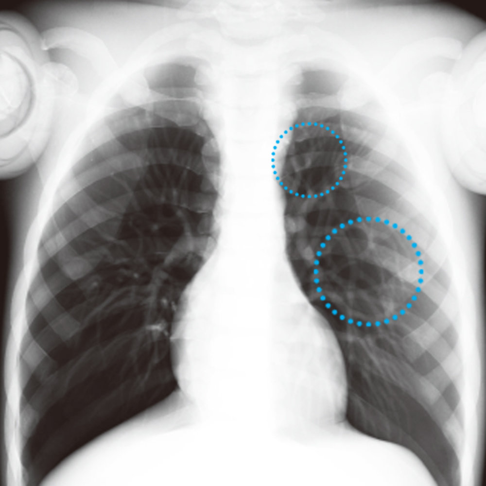 Paediatric Bone Fracture Phantom "PBU-70B"