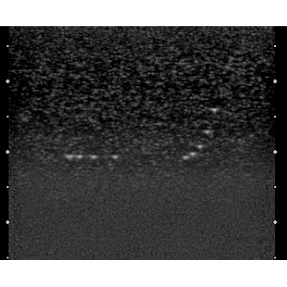 Breast Ultrasound QA Phantom